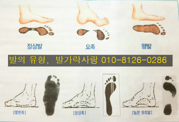 발가락 운동용구 듀트로 족저근막염 완치하세요.